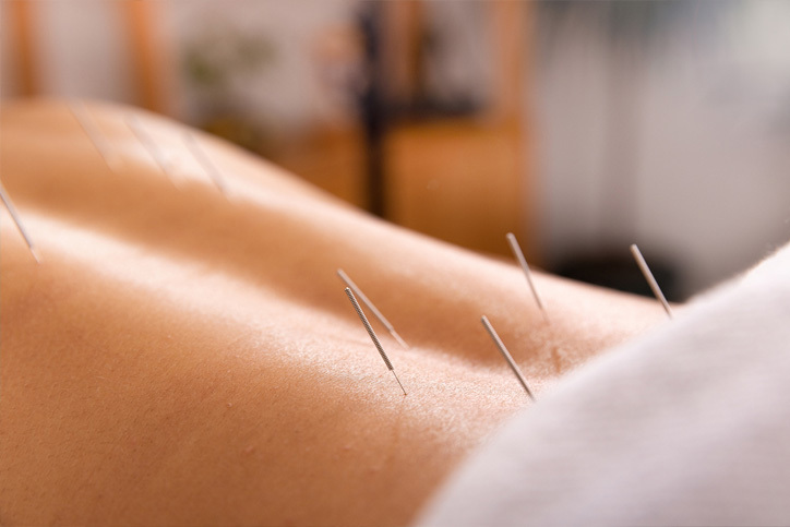 dry needling acupuncture treatment for low back pain